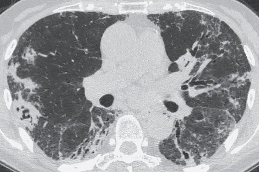 Инвазивный аспергиллез лёгких у больной после тяжёлого COVID-19