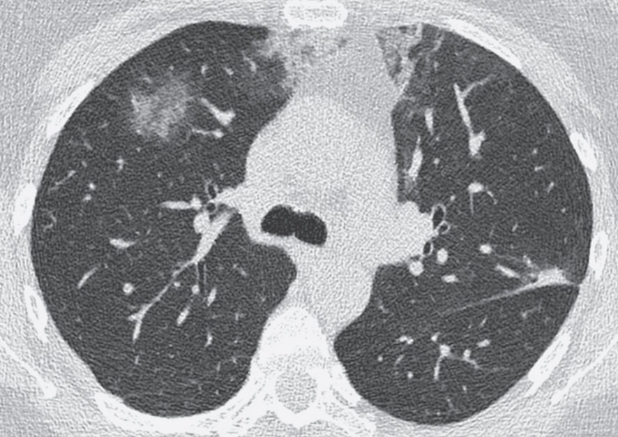 Интерстициальное заболевание лёгких